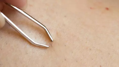 ขนคุดคืออะไร แนะนำวิธีรักษาขนคุด เปลี่ยนผิวหยาบกร้านให้เรียบสวย