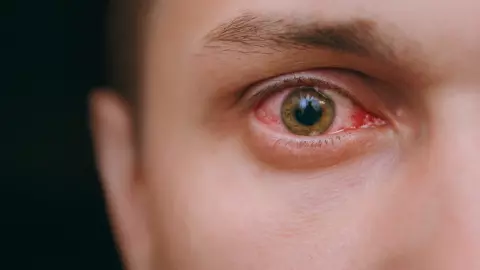 เช็กอาการ "เบาหวานขึ้นตา" รู้เร็ว รักษาไว ลดความเสี่ยงสูญเสียการมองเห็น