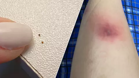 วอนผู้รู้ช่วยตอบ สาวถูกสัตว์ปริศนากัดขา เกิดตุ่มแดงคัน เกาจนเป็นแผลใหญ่