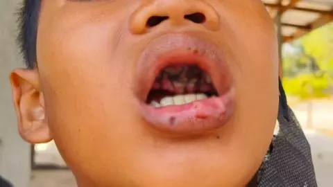  ม.1 เล่นแรงเตะปาก ป.5 ฟันหักยกแผง 4 ซี่ จ่ายค่าเสียหายกว่า 4 แสน