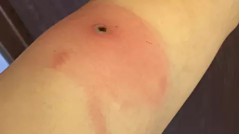 ผวา จนท.สหรัฐฯ ยืนยัน มีผู้ติดเชื้อไวรัส ‘อะแลสกาพ็อกซ์’ ตายรายแรก