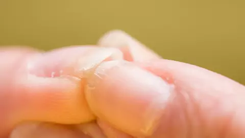 อันตรายเชื้อราที่เล็บรีบหาหมอ อย่าปล่อยทิ้งไว้นาน