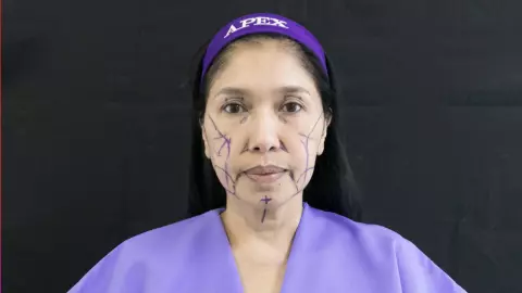 สวนกระแสดราม่า เอ้ ชุติมา ทำศัลยกรรมชุดใหญ่ 5 จุด 9 วันสวยทันใจรับงานได้ทันที