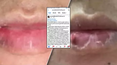 สักปากทำพิษ ผลลัพธ์ไม่ตรงปก สาวโวยคลินิกความงาม จี้คืนเงิน-ขู่แจ้งความ (คลิป)