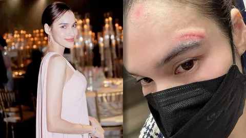 หยาดทิพย์ เล่าว่าเกิดอะไรขึ้น หัวแตกเย็บ 13 เข็ม หน้าเป็นแผล 9 เดือน