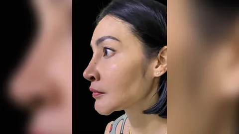 ดาราสาว เจอพิษซิลิโคนเหลวทั้งหน้า-นม ทรมานนานนับ 10 ปี 