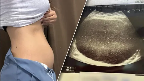 สาวเล่าอุทาหรณ์ ไม่กล้าตรวจภายใน สุดท้ายพบก้อนเนื้อขนาดใหญ่ 17 ซม.