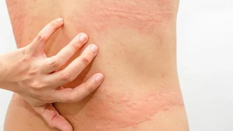 โลกผวา...! แบคทีเรียกินเนื้อคน Come back