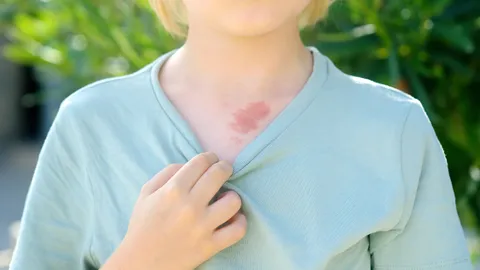 ทำนายตำแหน่งปานดำ ปานแดง ปานจุดไหนบอกวาสนา โชคลาภร่ำรวย หรืออาภัพรัก