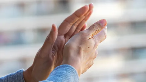 ไฝที่มือบอกนิสัย ไฝที่มือแบบไหนทรงเสน่ห์ มาดูตำแหน่งไฝที่ฝ่ามือกัน