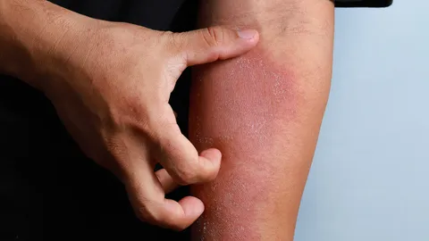 โรงพยาบาลหัวเฉียวแนะนำ ระวังสัตว์พิษฤดูฝน