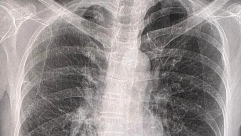 เตือนคนชอบปลูกต้นไม้ หลังหญิงวัย 64 ติดเชื้อวัณโรคเทียมจากการเทปุ๋ยคอก