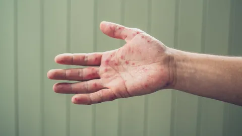 เตือนโรค "มือ เท้า ปาก" โรคระบาดที่มากับหน้าฝน พร้อมแนะวิธีการป้องกัน