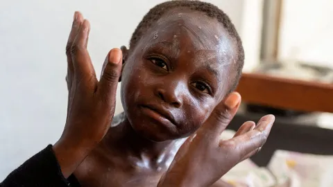 คองโกเผย คงไม่ได้รับวัคซีนฝีดาษลิงในสัปดาห์นี้ ตามที่องค์การอนามัยโลกเคยให้สัญญา