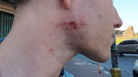 หนุ่มสวีเดน ถูกลิงพระปรางค์สามยอด กัดคอเจ็บ คาดเจอลิงหวงลูก