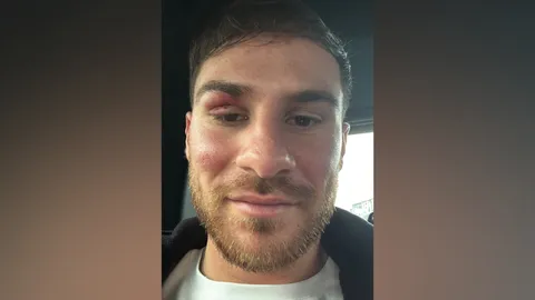 แข้งหงส์แตก 1 “แม็ค อัลลิสเตอร์” ได้แผลเพียบ! จากเกมปะทะ แมนฯ ซิตี้ ในพรีเมียร์ลีก