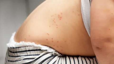 หมอแล็บเตือน "โรคไข้อีดำอีแดง" กำลังระบาด บางโรงเรียนต้องประกาศหยุดเรียน