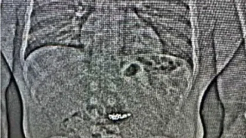 โจรปล้นร้านเพชรกลืนต่างหูเพชร มูลค่ากว่า 25 ล้านบาทลงท้อง หวังรอดการจับกุม