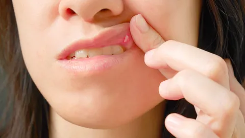 แนะนำ 10 วิธีแก้อาการร้อนใน บรรเทาแผลในปาก พร้อมวิธีป้องกันที่ควรรู้
