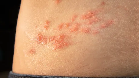 “โรคงูสวัด” อันตรายกว่าที่คิด แพทย์ย้ำ อายุ 50+ และมีโรคร่วมเสี่ยงปัญหาสุขภาพร้ายแรง