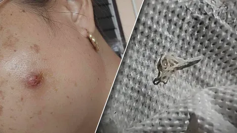 สยอง หมอเผยเคสหายาก สาวมีอาการคันเจอพยาธิหนอนหัวใจสุนัขปูดออกจากใต้ตา (คลิป)