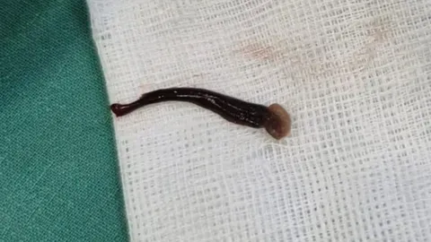 เด็ก 3 ขวบ กำเดาไหลไม่หยุด 4 วัน แพทย์ส่องจมูกเจอ "ปลิง" เกาะอยู่ (คลิป)