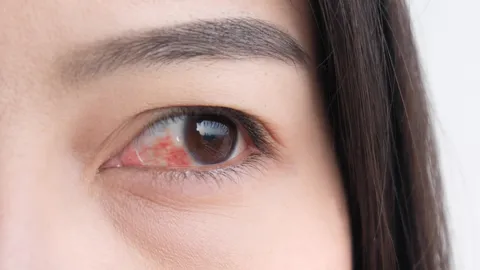 ตาแดงธรรมดา vs. ตาแดงติดเชื้อ แยกยังไงดี? รู้ไว้ก่อนเล่นน้ำสงกรานต์