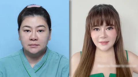 โอ๋ ภัคจีรา โพสต์รีวิวพลีชีพ เทียบภาพชัดๆ ก่อนและหลังศัลยกรรมวัย 48 ปี