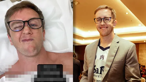 เนท My Mate Nate เตือนทุกคนให้ระวัง ต้องผ่าตัด 3 จุดเพราะไม่ชอบทาครีมกันแดด 