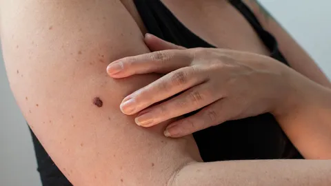 เปิดสาเหตุมะเร็งผิวหนัง อาการเป็นอย่างไร รักษาได้หรือไม่