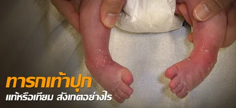ทารกเท้าปุก แท้หรือเทียม สังเกตอย่างไร