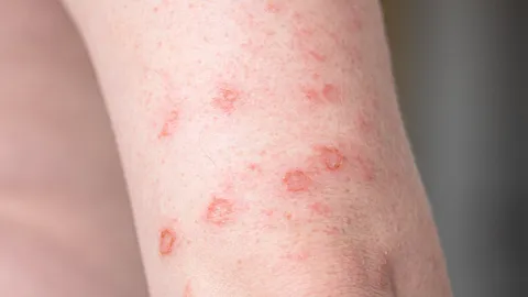 อย่าตระหนก แจงข่าวเตือนซิฟิลิสระบาด ในหมู่นักศึกษา 2 วันเจอ 3 รายพ่วง HIV