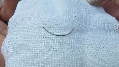 สาวสุดงง เจ็บเสียดในคอ เอกซเรย์พบเหล็กยาว 3 ซม. ไม่เชื่อว่าเป็นไสยศาสตร์