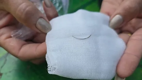 ไม่ใช่ก้างปลาติดคอ สาวเจอแท่งเหล็กเสียบฟันกรามจมมิด ไม่เชื่อโดนคุณไสยฯ (คลิป)