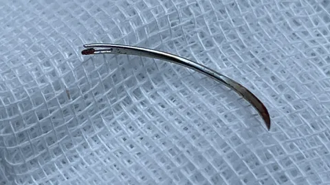 รู้แล้ว เหล็กปริศนาฝังติดฟันกราม เชื่อหมอลืมไว้ตอนผ่าฟันคุด 15 ปีก่อน