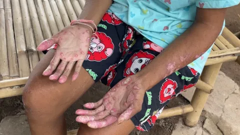 สาวป่วยมีแผลเรื้อรัง ทุกข์ทรมานมากว่า 3 ปี อยากไปรักษากับ ดร.เฉลิมพล