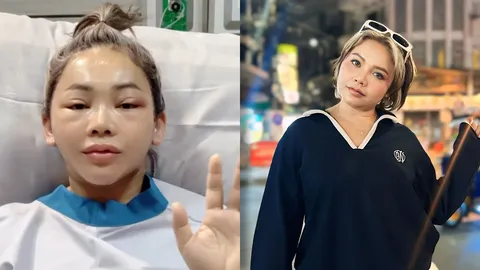 เปลี่ยนไปจนจำแทบไม่ได้ ตั๊กแตน ชลดา ขึ้นเขียงศัลยกรรมใบหน้า สวยจึ้งดูเด็กลงมาก