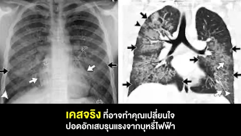 ฟังเคสจากผู้สูบพอด คนอาจเปลี่ยนใจ หากคุณคิดว่าสูบพอดไม่ร้าย ไม่อันตราย