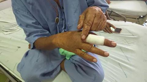 ป้าวัย 62 โดนงูกะปะฉก หลังเอื้อมไปเก็บก้อนกลมสีขาว คิดว่าเห็ด ที่แท้เป็นไข่งู