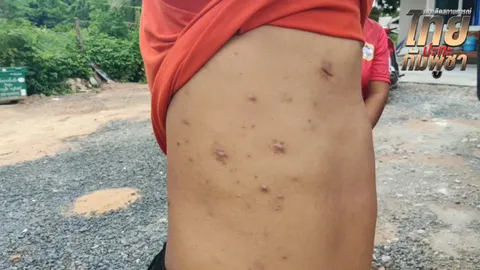 พ่อน้องน้ำโขง โชว์แผลทั่วร่าง จากสะเก็ดระเบิด BM21 รอฟังคำสั่ง พร้อมอพยพ