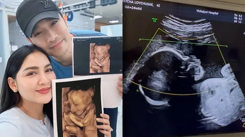 เจมส์-ครูก้อย อวดภาพอัลตราซาวนด์ น้องมีเมตตา ฉายแววน่ารัก จมูกโด่งตั้งแต่อยู่ในท้อง