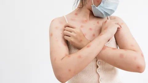 เปิดสาเหตุโรค “อีสุกอีใส” อาการเป็นอย่างไร พร้อมไขข้อสงสัย เคยเป็นแล้ว มีสิทธิ์เป็นซ้ำหรือไม่?