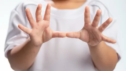 โรคอีสุกอีใสในเด็ก