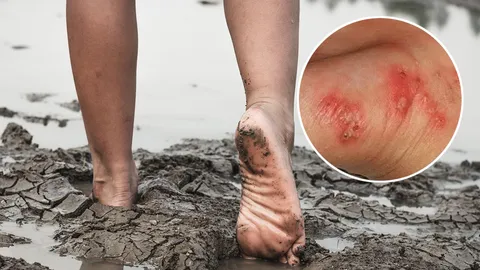 เตือนภัยระบาด "โรคไข้ดิน" ดับ 23 ราย 1 ม.ค.ถึง 16 เม.ย. ป่วย 732 ราย สัมผัสน้ำ-ดินสกปรก