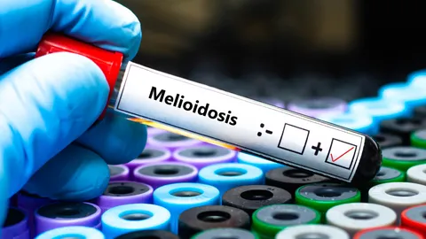 โรคไข้ดิน คืออะไร เปิดอาการ-วิธีป้องกัน “โรคเมลิออยด์” อันตรายถึงตายหากรักษาช้า