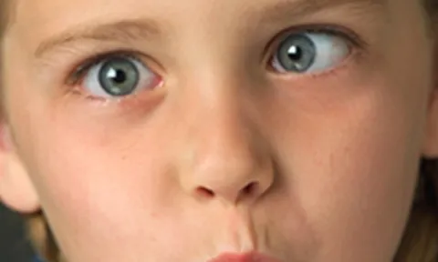 รู้จักกับตาเข – ตาเหล่ (Strabismus)
