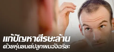 แก้ปัญหาศีรษะล้าน ด้วยหุ่นยนต์ปลูกผมอัจฉริยะ