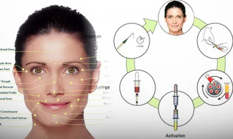  'Vampire Face Lift' นวัตกรรมหน้าเด็กเด้งอมตะ