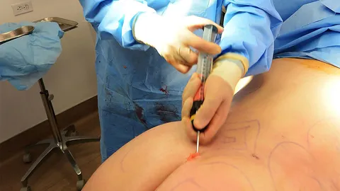 เมืองนางงามจักรวาลแห่กันไปเสริมสะโพก