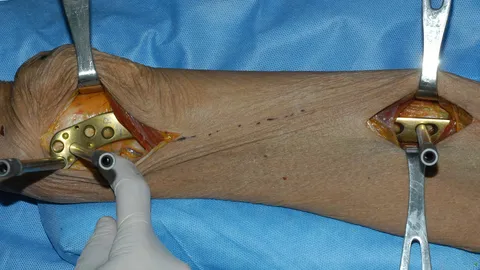 เผยเทคนิค 'ผ่าตัดกระดูกหัก' แบบใหม่ คว้ารางวัล 'วิจัยยอดเยี่ยม' 